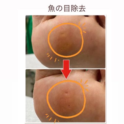 足裏タコ、魚の目、小爪ケア　※フットバス付きのメニューの方は+¥1500／1本〜