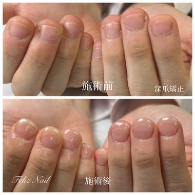 【トラブル爪】深爪矯正