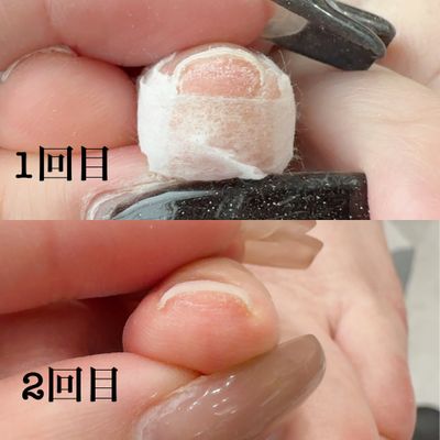巻き爪ケアジェル（親指2本）+ジェルワンカラー