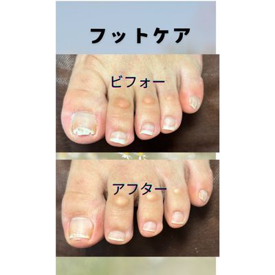 フットケア