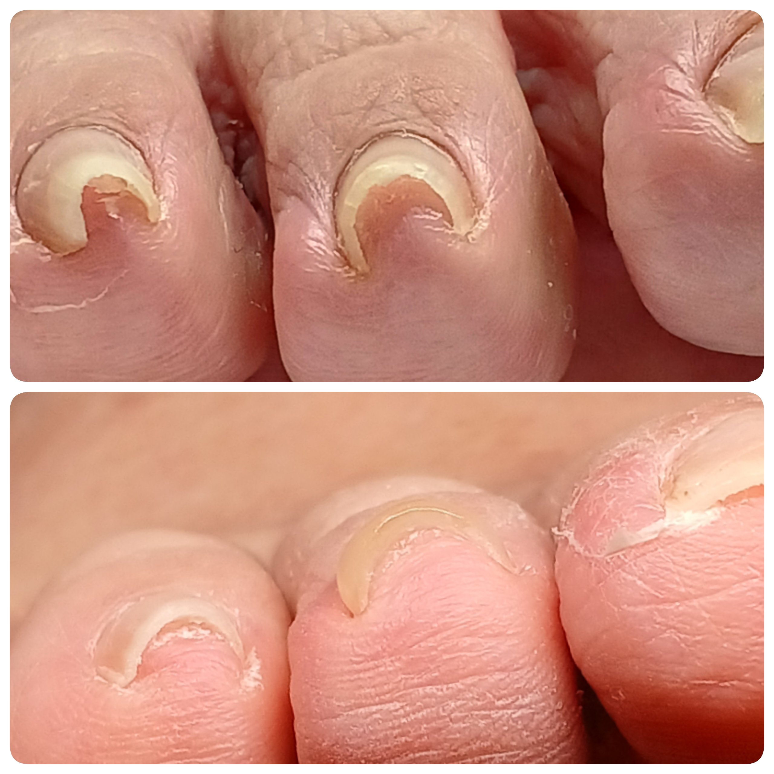 378nail
